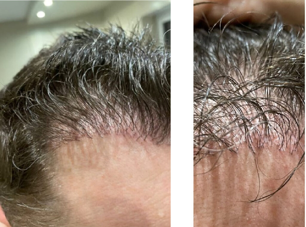 1 an après la greffe de cheveux turquie