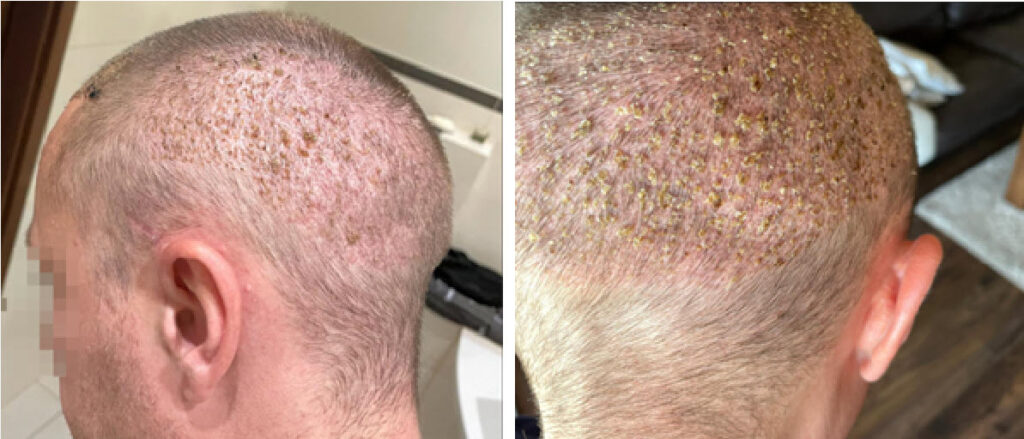 3 semaines après la chirurgie de greffe de cheveux