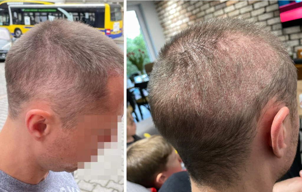 5 mois après la greffe de cheveux surexploitée