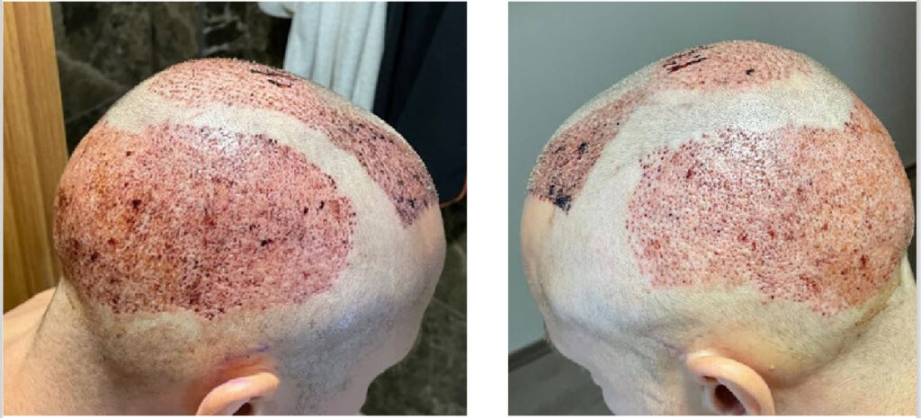 après la greffe de cheveux turquie