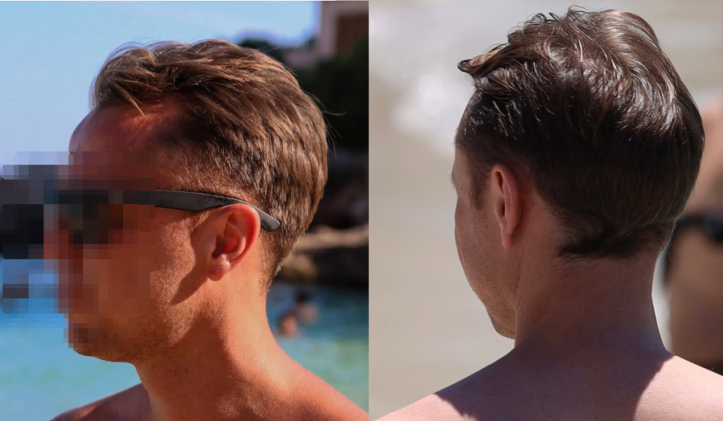 avant la greffe de cheveux