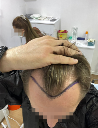 avant la greffe de cheveux clinique illégale
