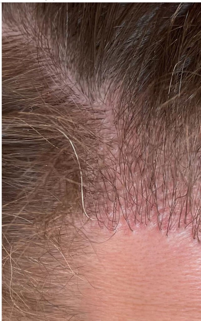 résultats de greffe de cheveux 1 an marché noir