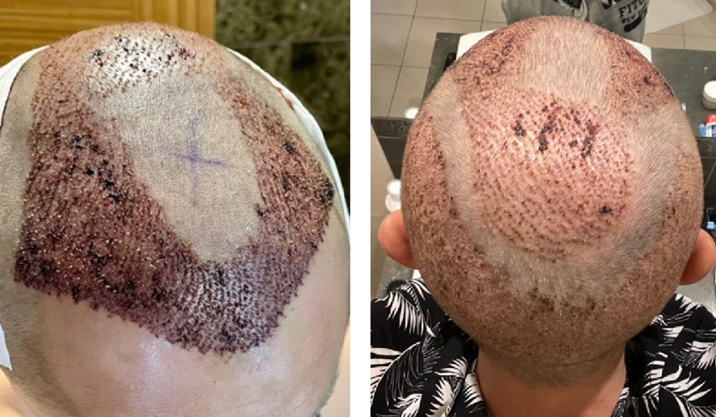 une semaine après la chirurgie de greffe de cheveux turquie