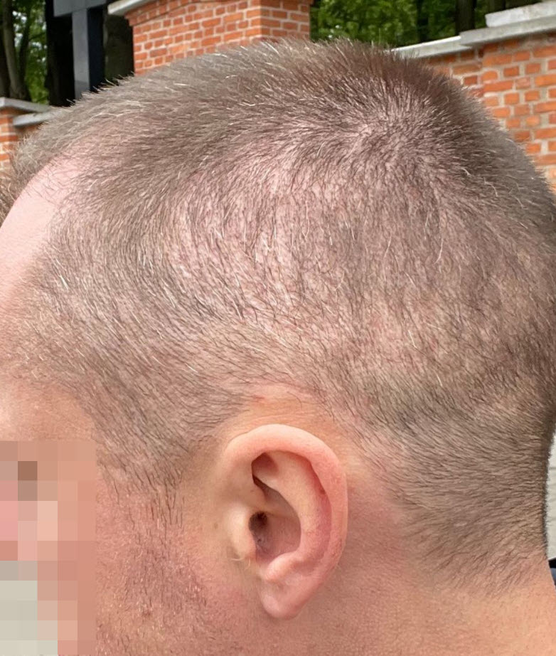 greffe de cheveux de zone donneuse surexploitée
