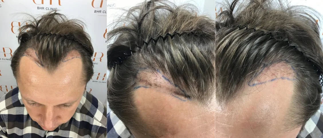 14 mois après la réparation de la greffe de cheveux