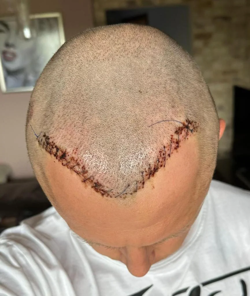 après la réparation de la greffe de cheveux