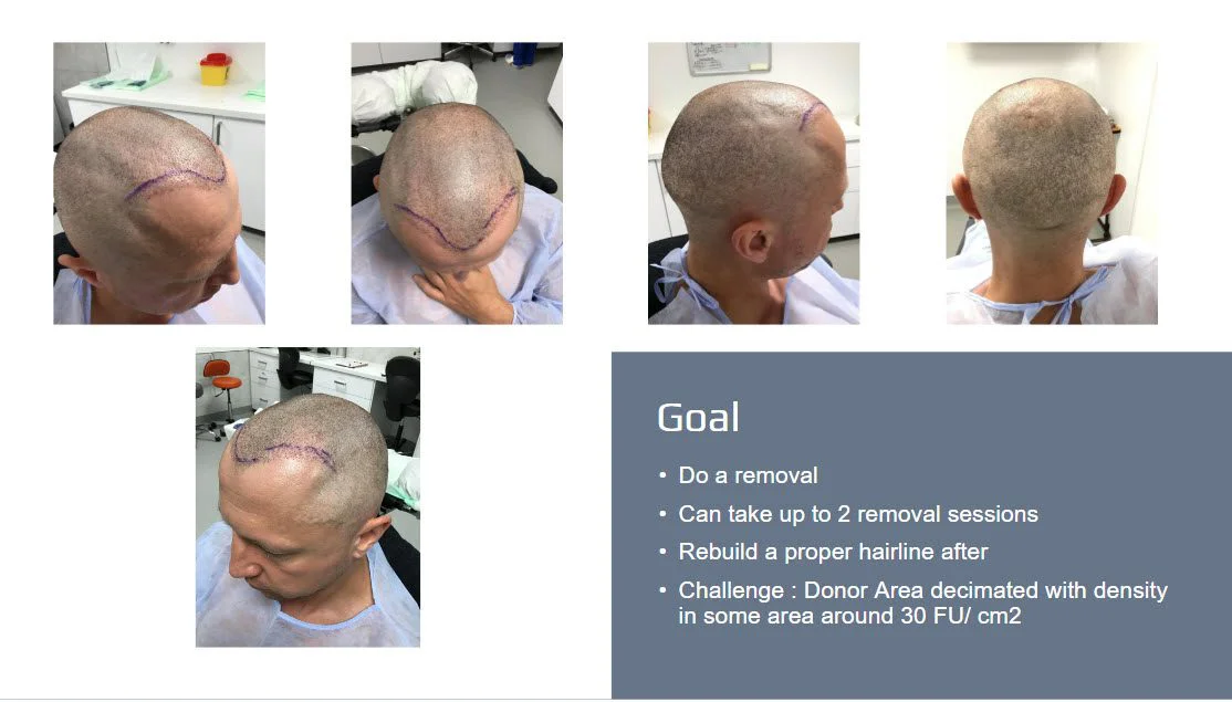 réparation de greffe de cheveux